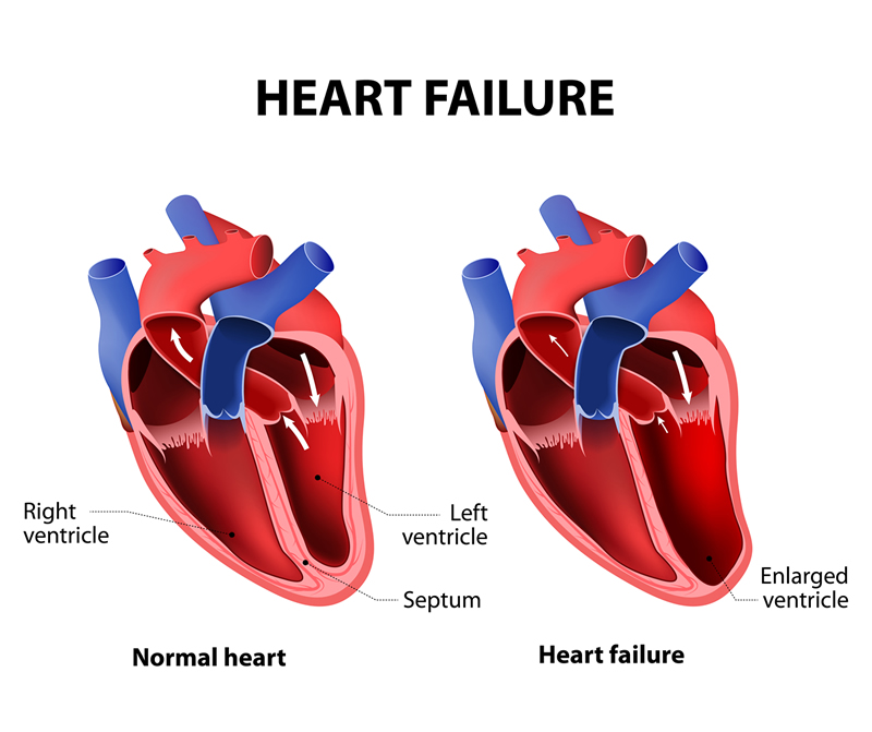 Congestive Heart Failure