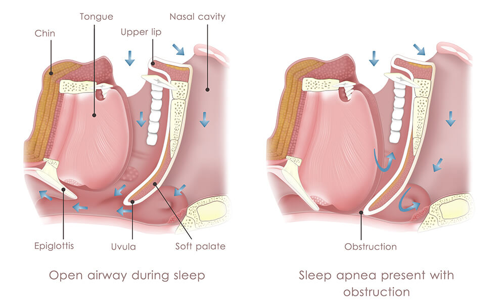 sleep apnea