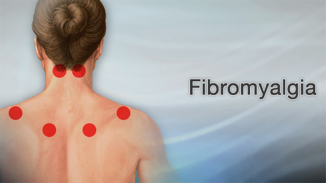 What is the Main Cause of Fibromyalgia?