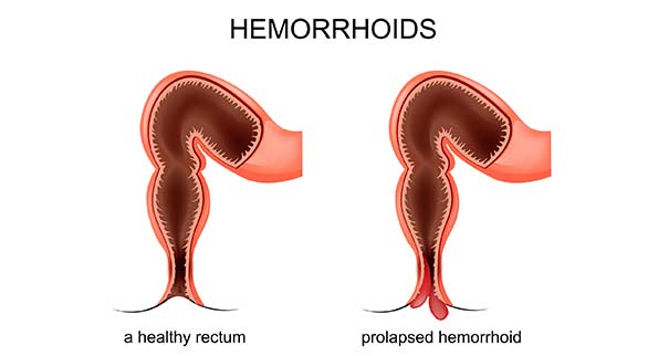 Hemorrhoids