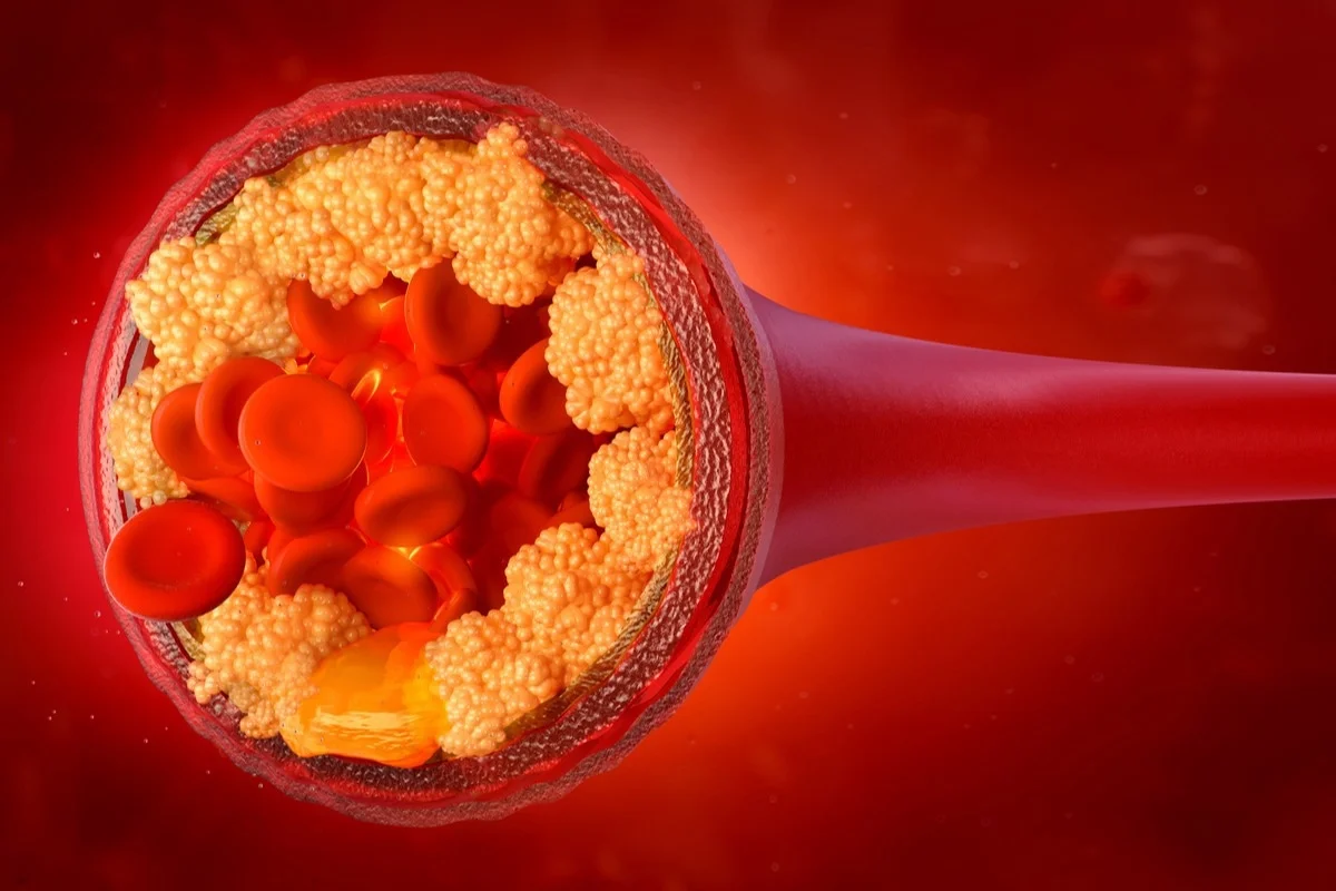 ldl cholesterol