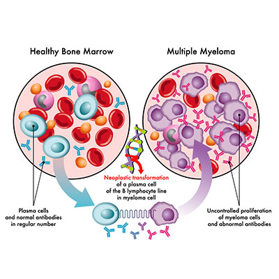 What is the Main Cause of Myeloma?