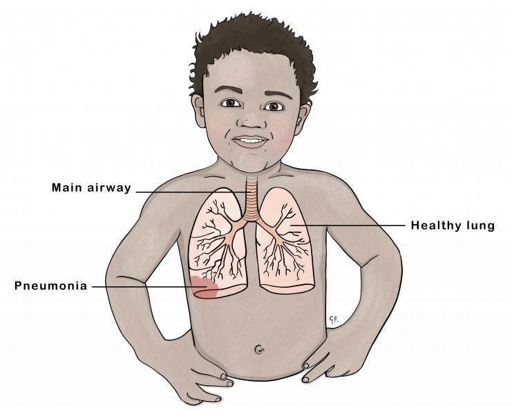 Pneumonia 