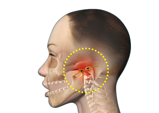 Ankylosis