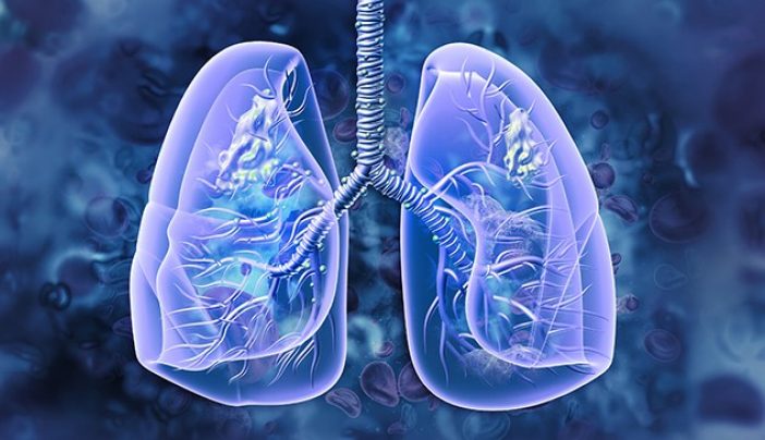 What is Stage 4 lung cancer?