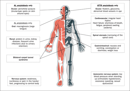 Is Amyloidosis a Myeloma?