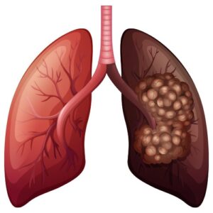 lung cancer