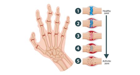 Rheumatoid Arthritis