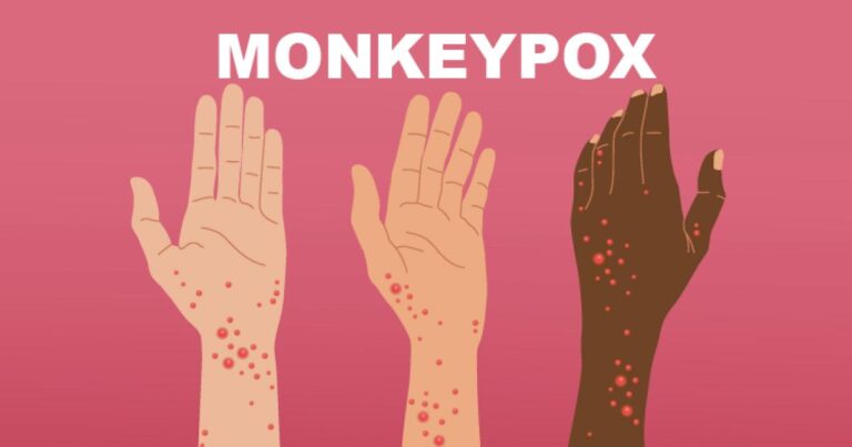Can Monkeypox be cured?